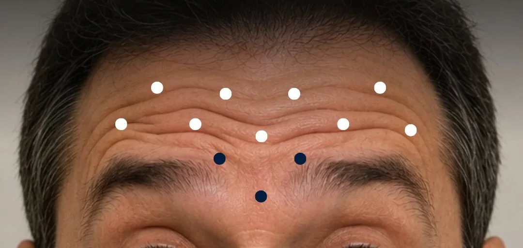 Testa do paciente com os pontos de aplicação: brancos no músculo frontal e azuis na glabela
